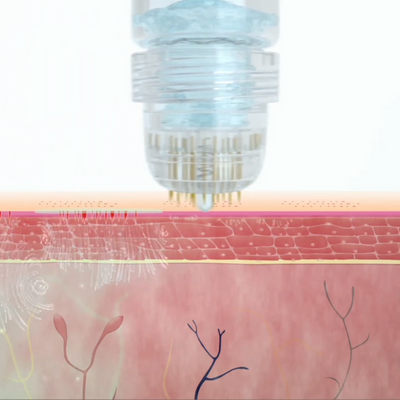 Calvita® - Technologie Capillaire  MicronInfuse