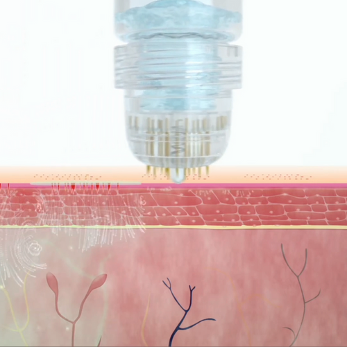 Calvita® - Technologie Capillaire  MicronInfuse